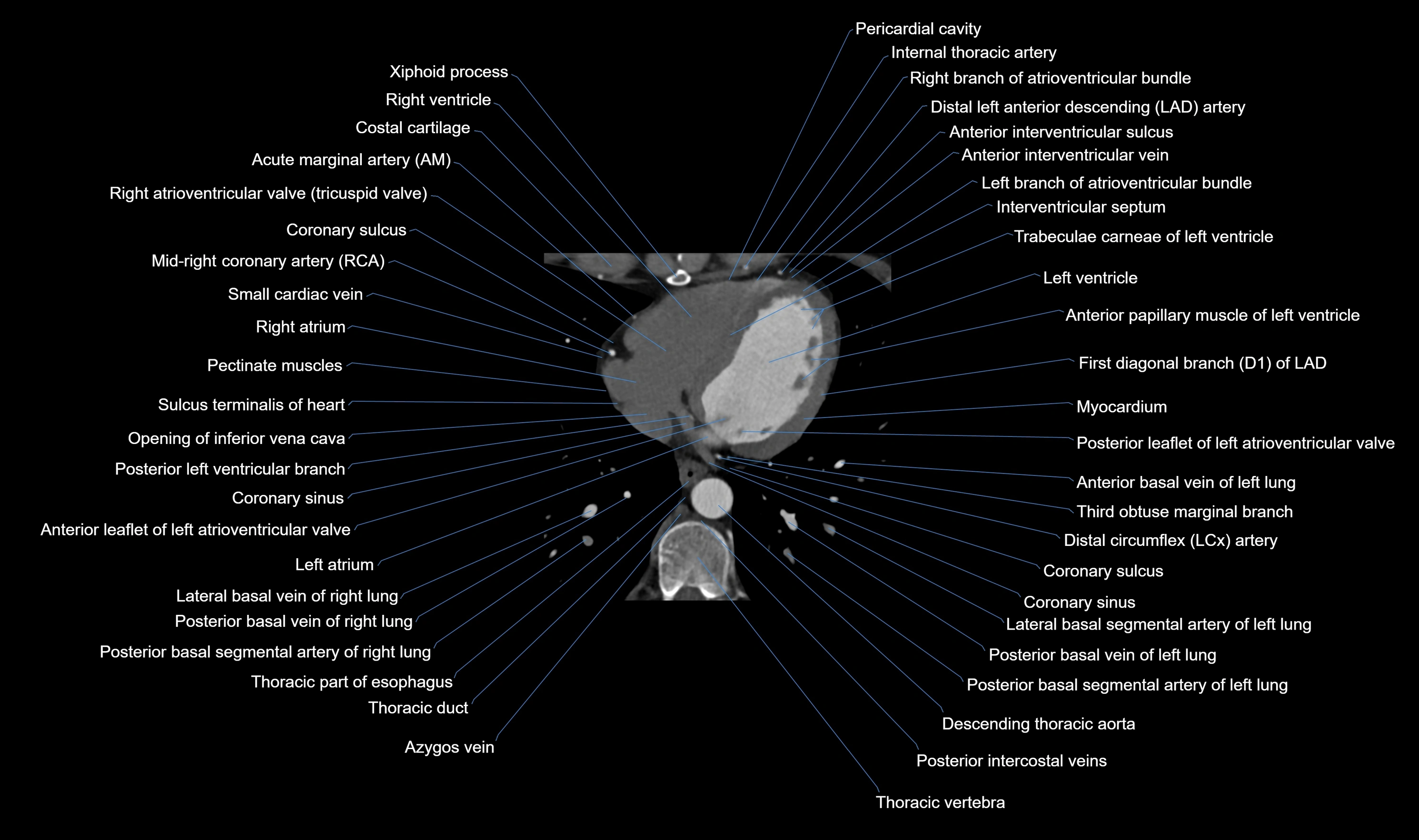 CT heart (coronary angiogram) axial view cross sectional anatomy labelled radiology image-00048.webp